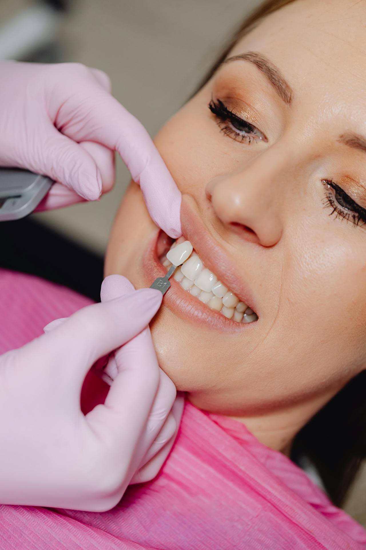 Veneers